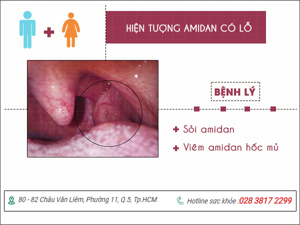 Vòm họng có lỗ là triệu chứng bệnh gì? có nguy hiểm không?