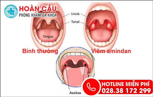 Biến chứng sau cắt amidan là gì?