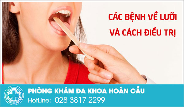 Các bệnh về lưỡi thường gặp nhưng không phải ai cũng biết