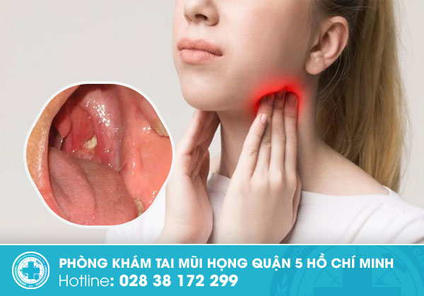 Cổ họng có hạt trắng lớn nhỏ là bị bệnh gì?