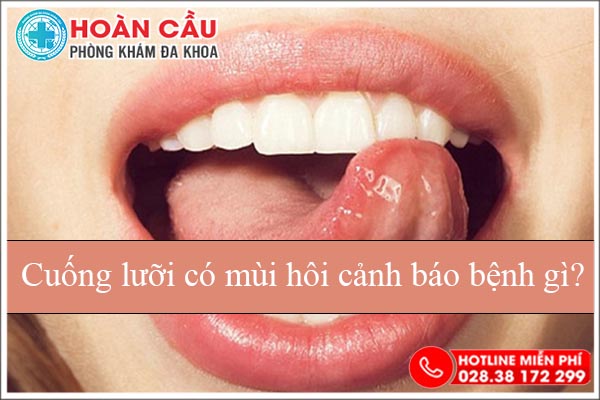 Cuống lưỡi có mùi hôi dấu hiệu cho thấy bạn đã mắc bệnh nguy hiểm