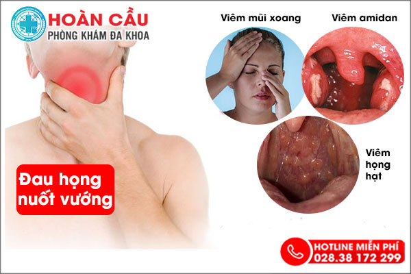 Đau họng nuốt vướng có thực sự nguy hiểm?