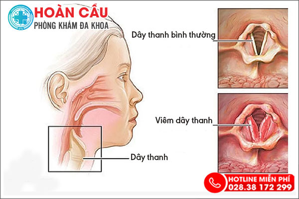 Khàn tiếng kéo dài - Cần cảnh giác với các bệnh lý nguy hiểm