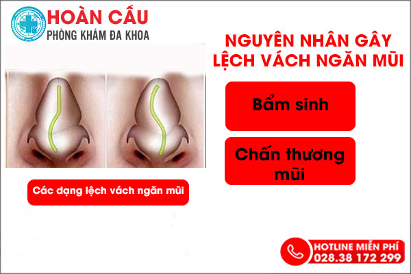 Tiết lộ nguyên nhân gây lệch vách ngăn mũi và địa chỉ chữa trị uy tín