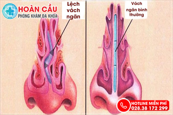 Hậu Quả Của Vẹo Vách Ngăn Mũi