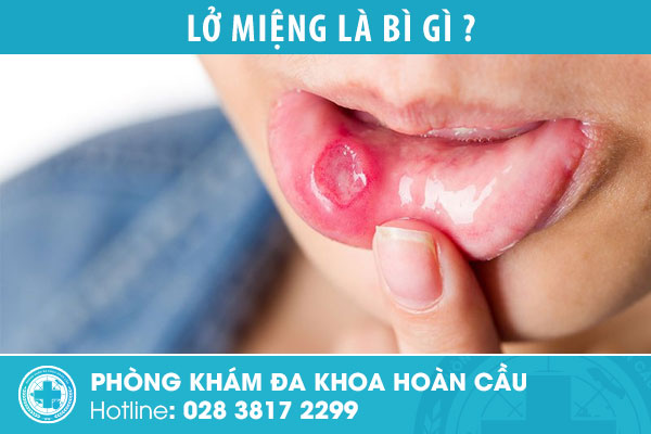 Lở miệng: Nguyên nhân, Triệu chứng và Cách điều trị