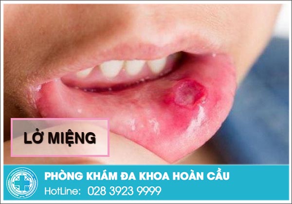 Lở miệng có thật sự nguy hiểm không? Làm sao để chữa khỏi