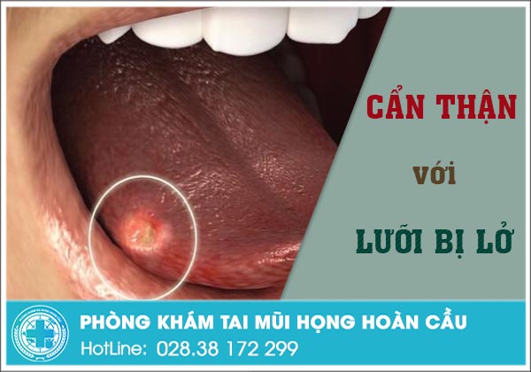 Lưỡi bị lở nguy hiểm như thế nào?