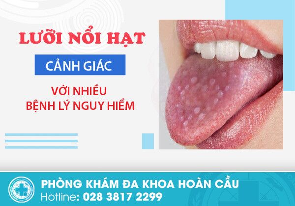 Hiện tượng lưỡi nổi hạt cảnh báo điều gì?