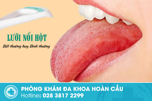 Lưỡi nổi hột là bình thường hay bất thường?