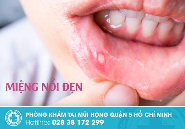 Miệng nổi đẹn có phải là bệnh nguy hiểm không?