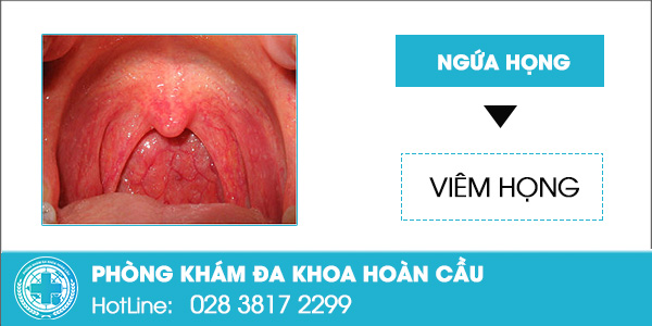 Ngứa họng kéo dài: Nguy cơ mắc phải những căn bệnh nguy hiểm