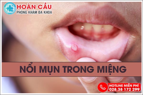 Nổi hột đỏ trong miệng là bệnh gi?