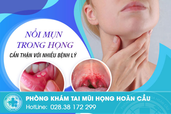 Nổi mụn trong họng là bị làm sao? Có nghiêm trọng không?