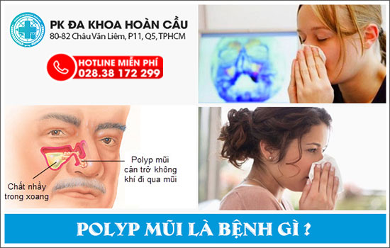 Polyp mũi có nên mổ không?