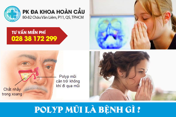 Polyp mũi là bệnh gì? có nguy hiểm không?