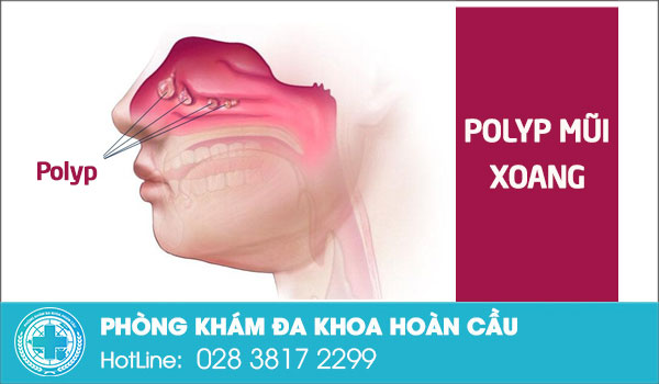 Polyp mũi xoang - căn bệnh tai mũi họng nguy hiểm