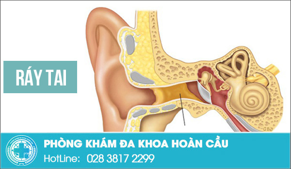 Ráy tai có màu có mùi liệu có đáng lo?