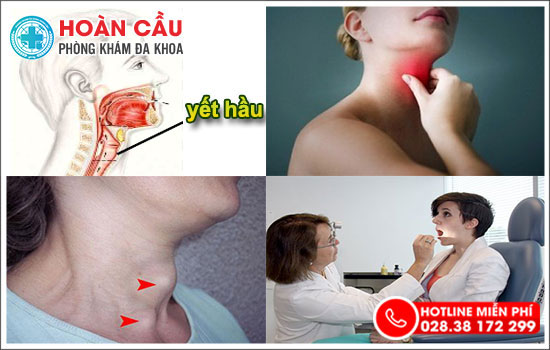 Sưng đau Yết Hầu Là Triệu Chứng Căn Bệnh Gì 3888