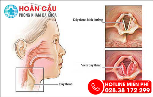 Những nguyên nhân gây nên polyp thanh quản