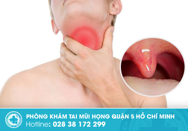 Thế nào là bệnh viêm họng lưỡi gà dài và dấu hiệu nhận biết?