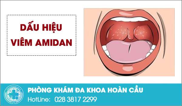 Dấu hiệu bệnh viêm amidan dễ nhận biết mà bệnh nhân nên chú ý