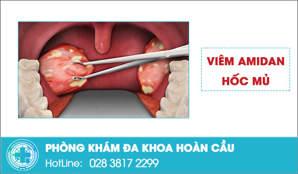 Cẩn thận với căn bệnh viêm amidan hốc mủ